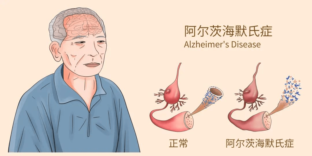 阿爾茨海默病有哪些癥狀丨如何診斷阿爾茨海默病？