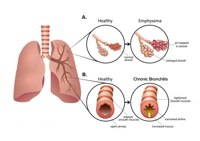 圖2：慢性阻塞性肺疾病 (COPD) 是一組導(dǎo)致呼吸困難的肺部疾病。A.肺氣腫導(dǎo)致肺泡氣囊受損和僵硬。空氣被困在肺泡中，導(dǎo)致呼氣困難。B.慢性支氣管炎會(huì)導(dǎo)致氣道腫脹和粘液增多。多余的粘液使呼吸困難并導(dǎo)致慢性咳嗽