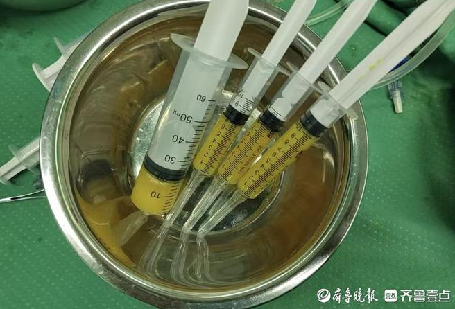 孫濤主任采用的自體脂肪微片段治療術，為她的治療帶來了新的轉機