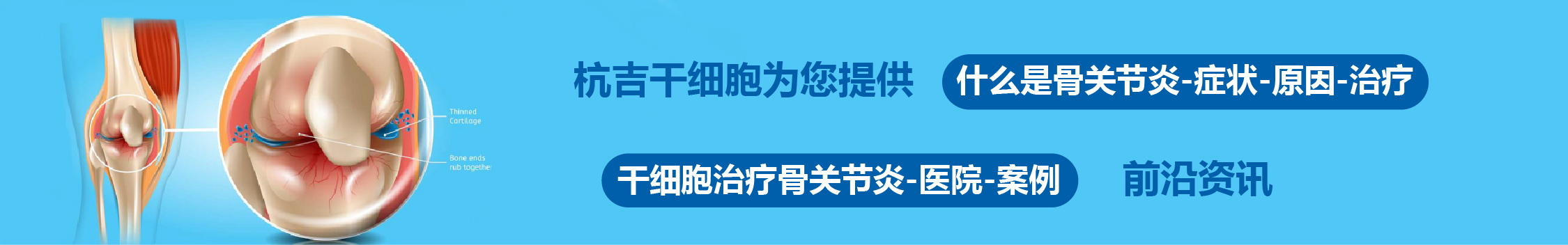 國(guó)內(nèi)外干細(xì)胞醫(yī)院治療骨關(guān)節(jié)炎的臨床案例