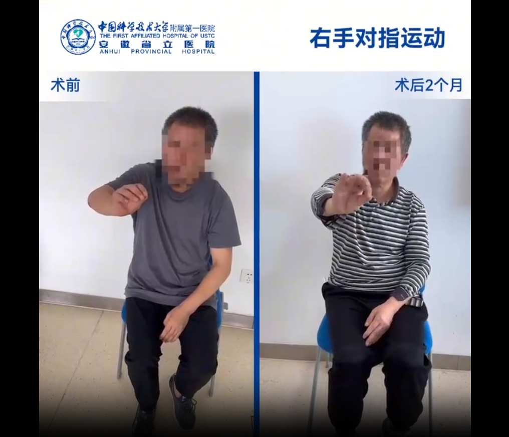 國內(nèi)誘導(dǎo)多能干細胞療法新突破：首例早發(fā)型帕金森病成功給藥，當(dāng)天即可行走