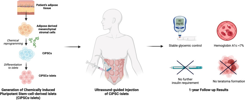 圖示：?通過將患者脂肪組織提取的間充質(zhì)干細胞化學重編程為誘導多能干細胞并分化為胰島，再注射入腹直肌前鞘。