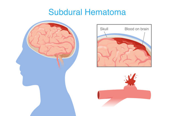 神經(jīng)干細(xì)胞移植治療腦出血的系統(tǒng)評(píng)價(jià)：NSC來(lái)源、輸送途徑、治療機(jī)制和早期臨床試驗(yàn)