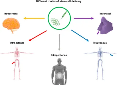 干細胞移植途徑：該圖展示了用于中風治療的干細胞輸送途徑，包括腦內（立體定向注射）、血管內（靜脈/動脈）、腹腔內、腦室內、靜脈內、鼻內和鞘內注射方法。
